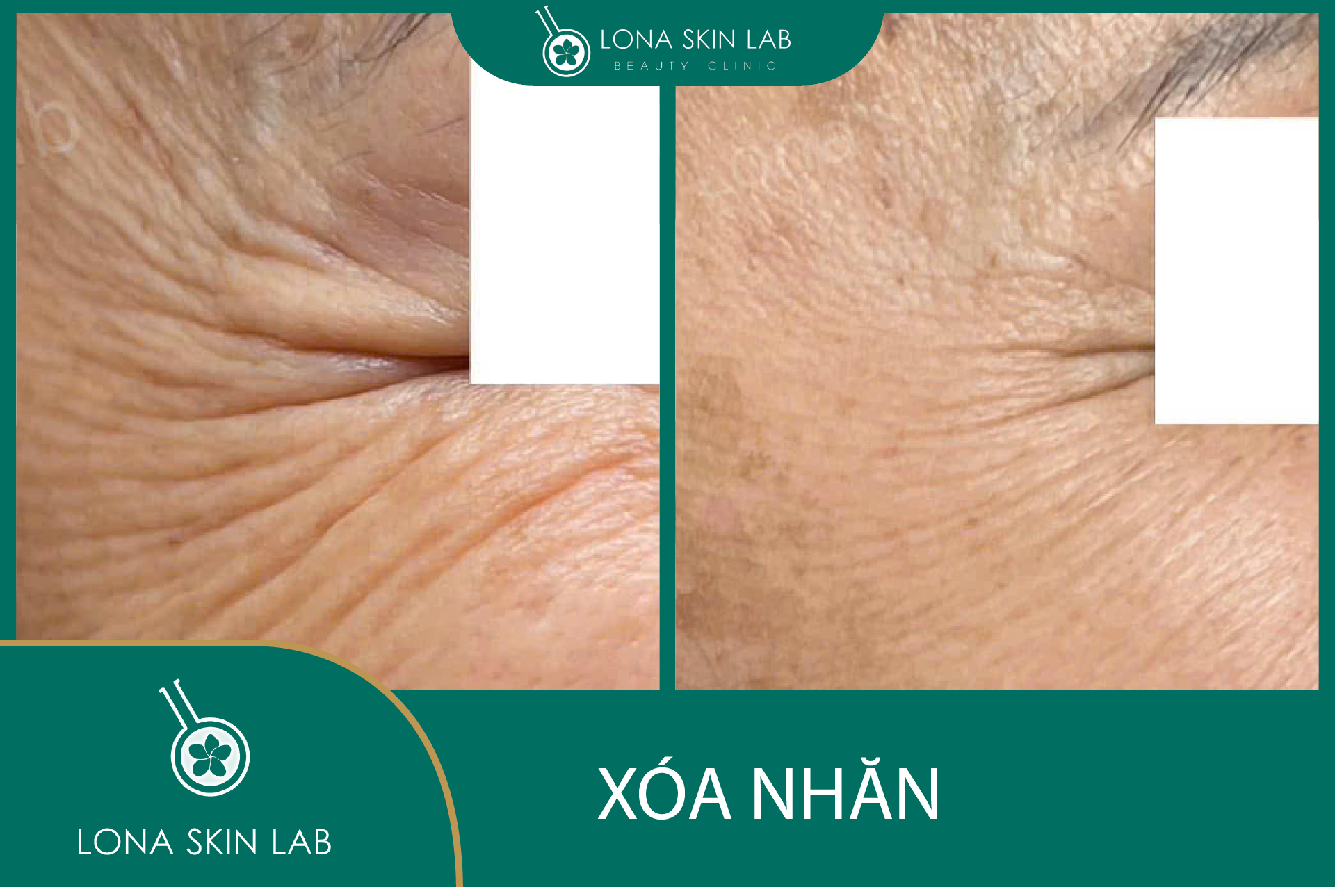 Ứng dụng công nghệ Oxyjet Cool trong chăm sóc da mụn cho phép điều trị mụn hiệu quả và trẻ hóa da, minh chứng cho hiệu quả của công nghệ Oxyjet qua quy trình tích hợp hiện đại.