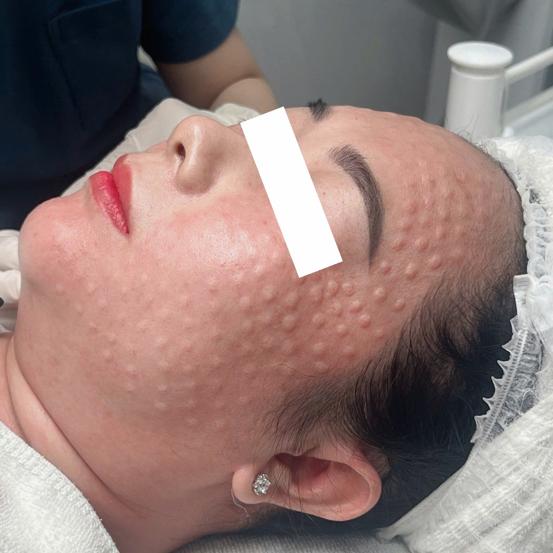 Dựa trên kinh nghiệm da liễu, tiêm meso mụn giúp làm sáng da và kiểm soát mụn, giải thích 'meso mụn là gì' thông qua các loại meso trị mụn và xác định tiêm meso mụn bao lâu có hiệu quả sớm.