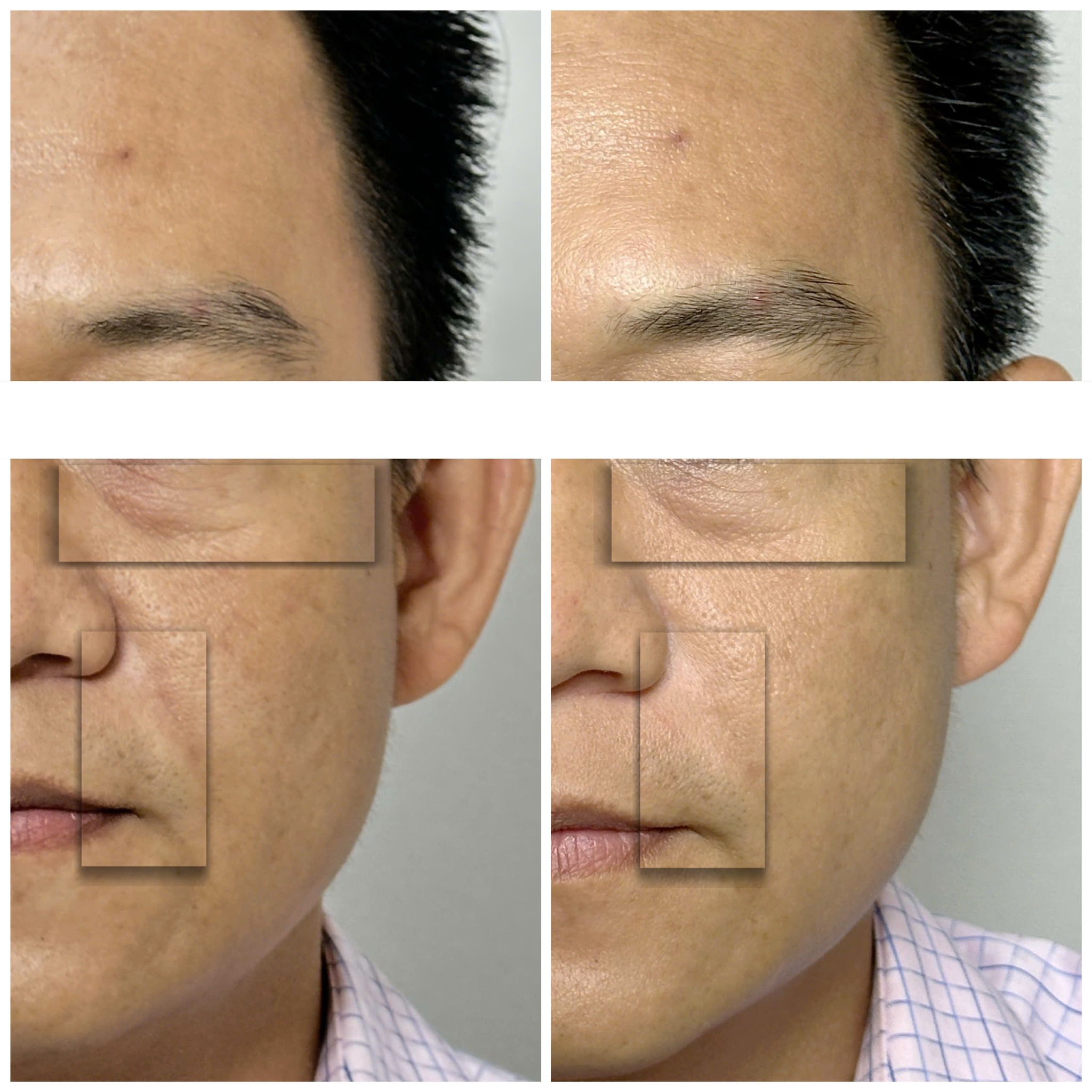 Ảnh này phản ánh công nghệ IPL tiên tiến trong việc điều trị mụn bằng IPL, khẳng định ưu điểm IPL khi mang lại hiệu quả IPL trị mụn cao.