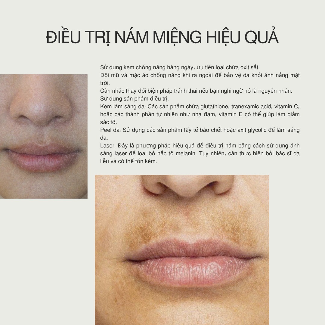 Minh họa laser trị nám qua phương pháp laser trị nám hiệu quả, đồng thời khuyến cáo chăm sóc da sau laser trị nám cẩn thận để ngăn ngừa tác dụng phụ của laser trị nám.