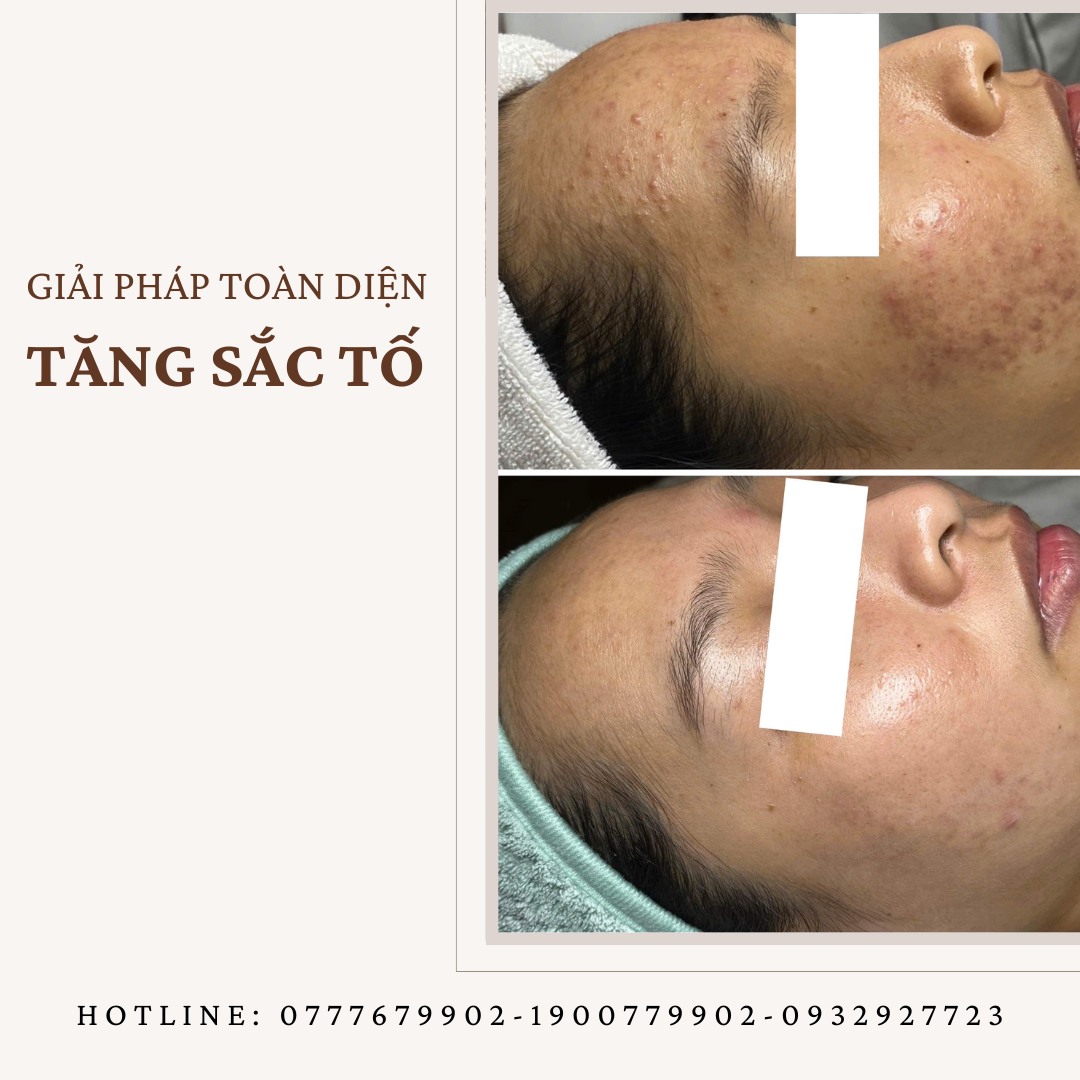 Trước và sau điều trị tăng sắc tố (nám mảng)