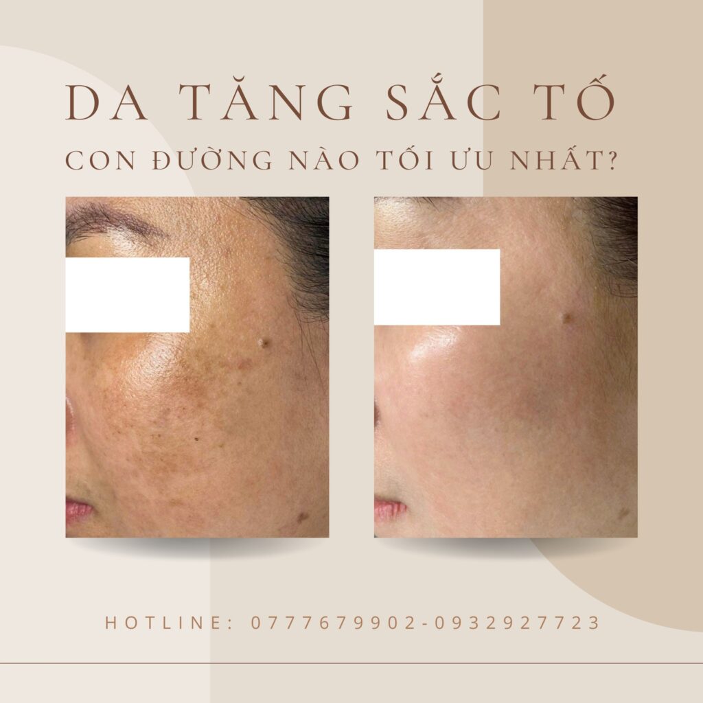 Da tăng sắc tố hình thành mảng