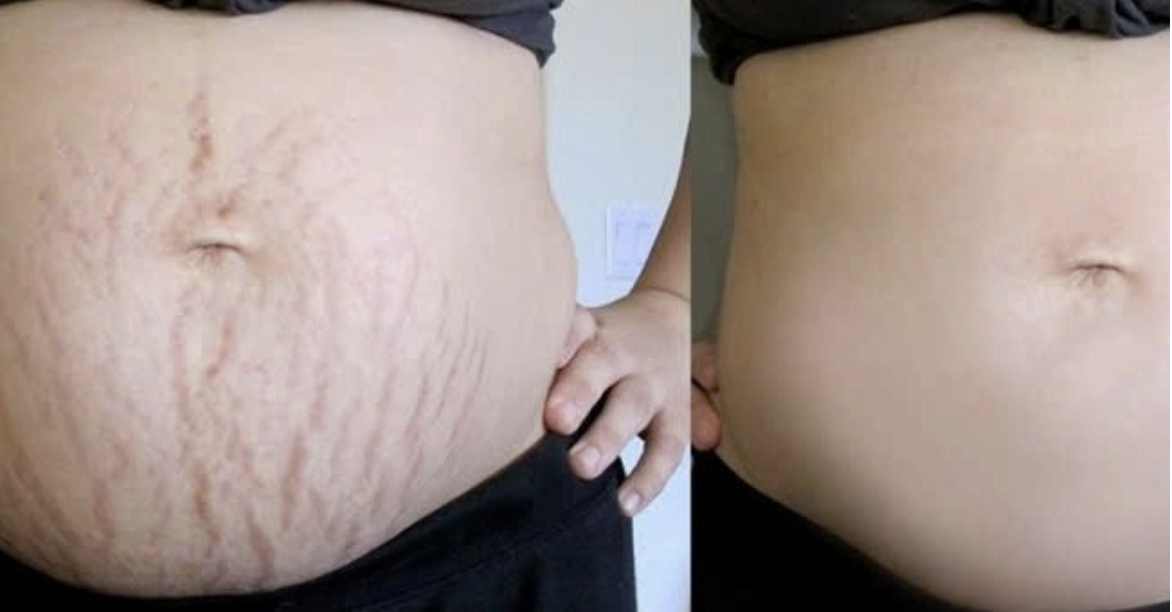 Hình ảnh về rạn da liên quan đến giãn mao mạch, cung cấp thông tin về điều trị giãn mao mạch và phòng ngừa qua các phương pháp hiện đại.