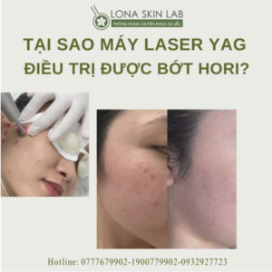 TẠI SAO MÁY LASER YAG ĐIỀU TRỊ ĐƯỢC BỚT HORI?