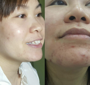 Điều trị sẹo rỗ bằng Laser CO2 Fractional tại Lona Skin Lab