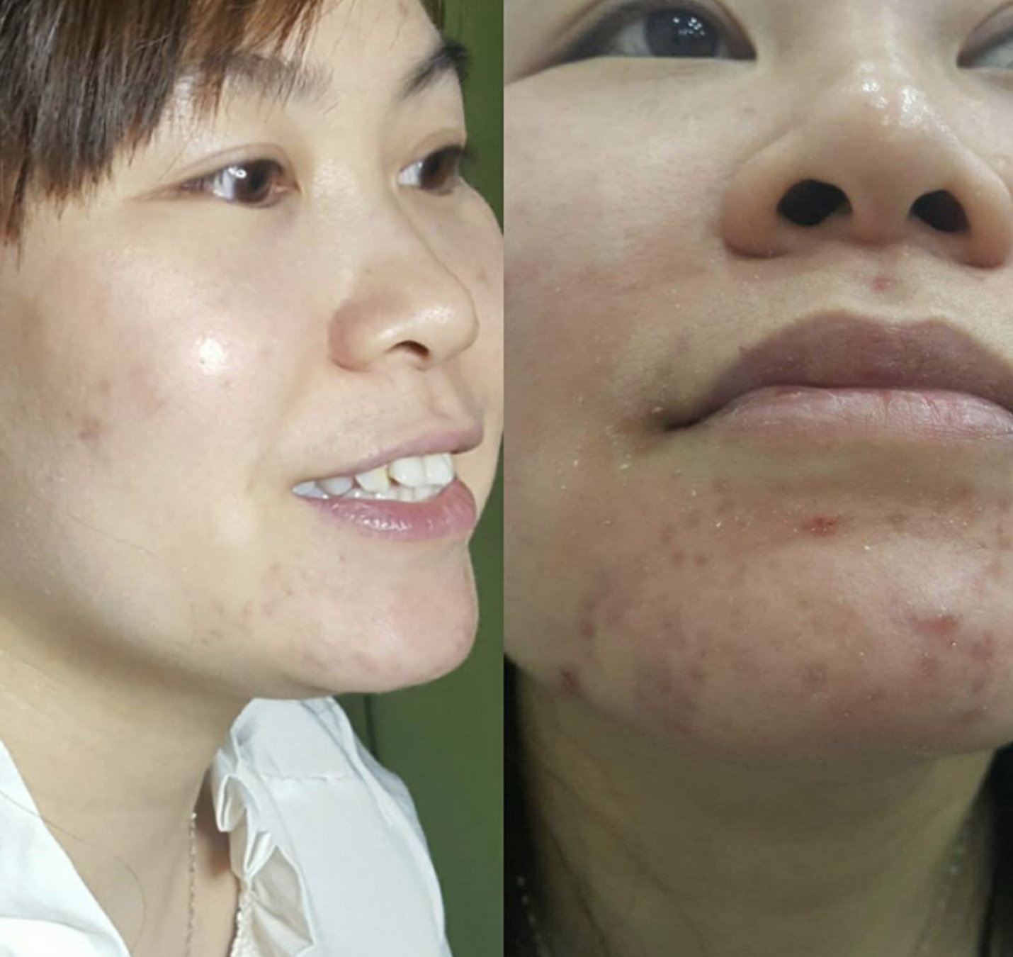 Hình ảnh cho thấy giãn mao mạch ở mặt cải thiện sau điều trị bằng laser. Mặt bị giãn mao mạch được xử lý kỹ càng, trị giãn mao mạch chân đạt hiệu quả, đồng thời giải đáp liệu giãn mao mạch có tự khỏi không.