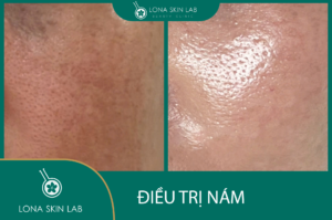 Điều trị nám bằng Laser - kết quả sau điều trị