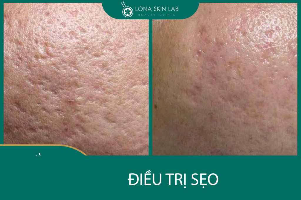 Điều trị sẹo lõm tại Lona Skin Lab