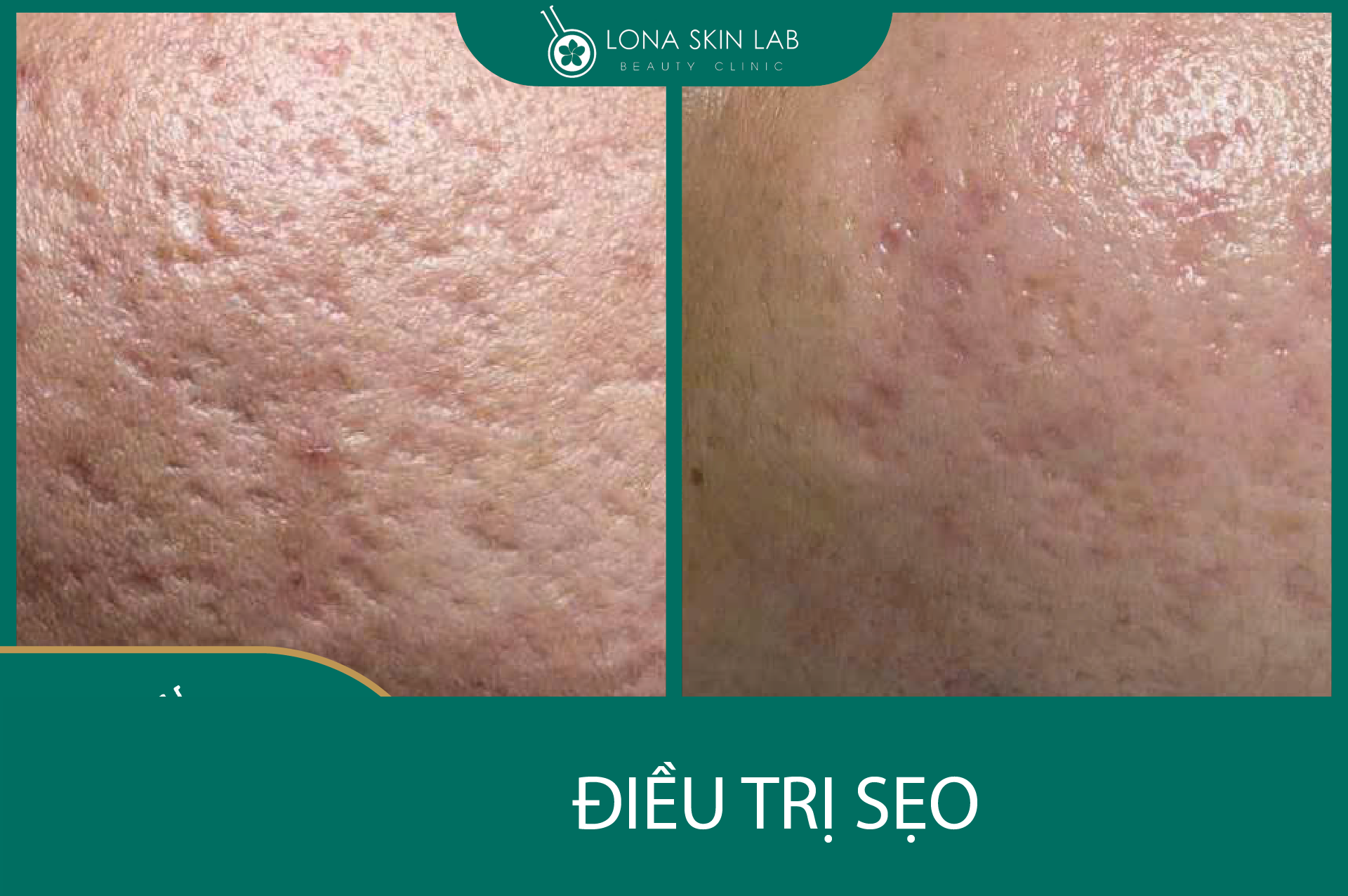 Công nghệ điều trị sẹo lõm hiện đại giúp phân biệt sẹo lồi và sẹo lõm trong quy trình điều trị sẹo.