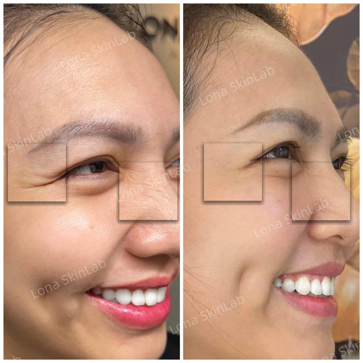 Đánh dấu bước tiến trong thẩm mỹ, công nghệ HIFU được ứng dụng qua HIFU giảm bọng mắt, giúp trẻ hóa da vùng mắt và hỗ trợ nâng cơ mắt không phẫu thuật, góp phần tạo nên hiệu quả HIFU vùng mắt đạt chuẩn chuyên gia.