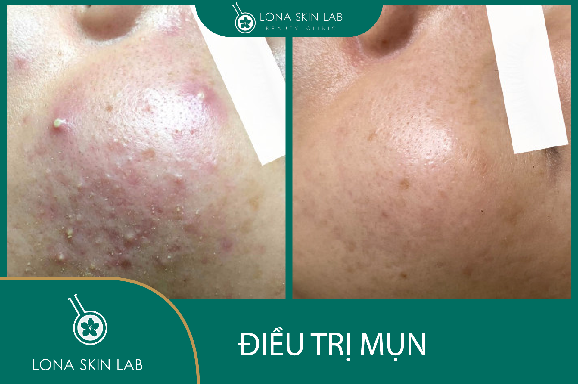 Hình ảnh đại diện cho phương pháp điều trị mụn bằng lợi khuẩn kết hợp probiotic trị mụn, minh họa cách trị mụn tự nhiên nhờ lợi khuẩn cho da và chăm sóc da mụn an toàn.