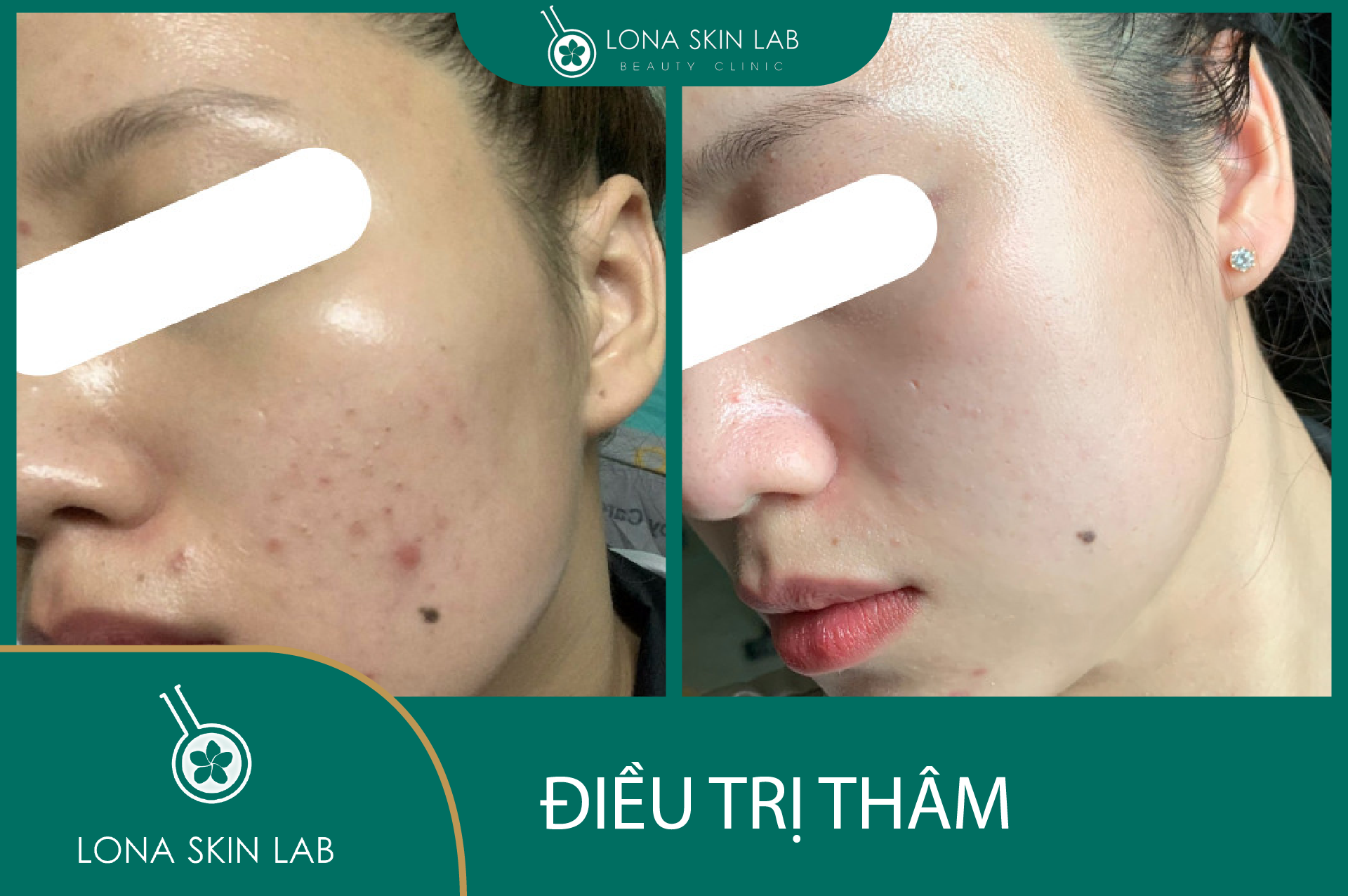 Ứng dụng exosome trị rụng tóc kết hợp laser kích thích tóc vào liệu trình điều trị rụng tóc chuyên sâu giúp tái tạo nang tóc và làm giảm tình trạng viêm nền, qua đó nâng cao hiệu quả điều trị.