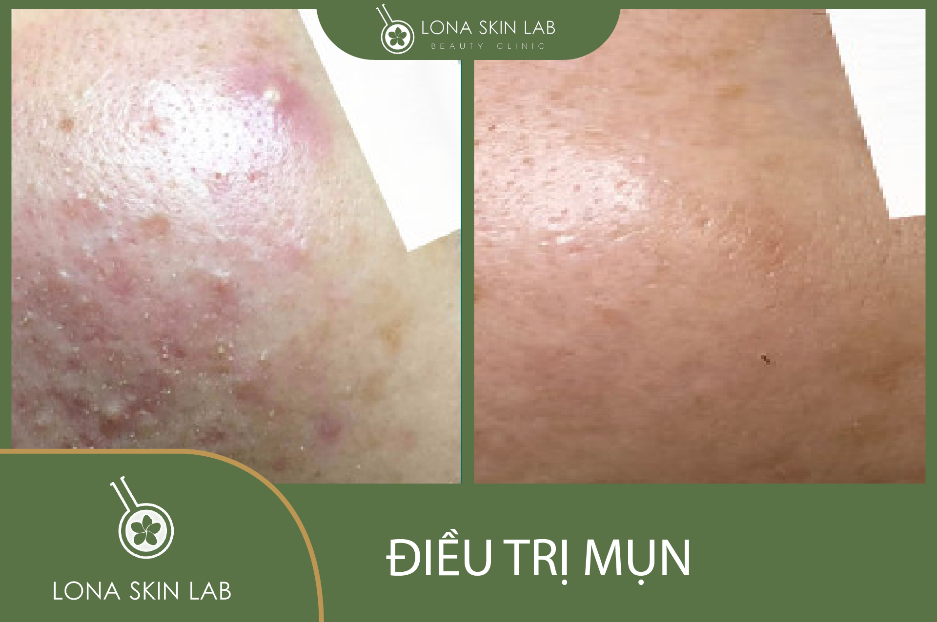 Hình ảnh chuyên sâu về điều trị mụn bằng lợi khuẩn, kết hợp probiotic trị mụn, thể hiện cách trị mụn tự nhiên nhờ việc bổ sung lợi khuẩn cho da và chăm sóc da mụn hiệu quả.