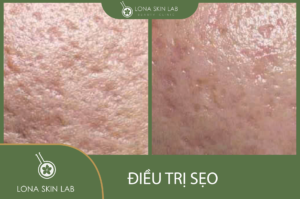 Điều trị sẹo tại Lona Skin Lab