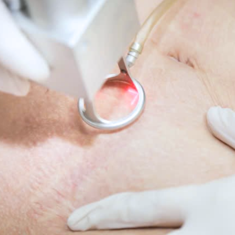 Hình ảnh Laser CO2 Fractional minh họa cách chăm sóc da sau laser, nhấn mạnh điều trị rạn da và lưu ý khi điều trị rạn da thông qua công nghệ laser CO2 tiên tiến.