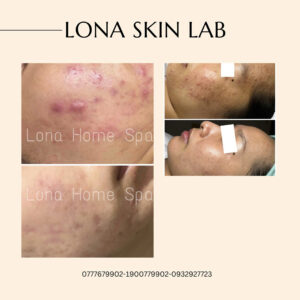 Tình trạng tăng sắc tố sau viêm ( thâm mụn )