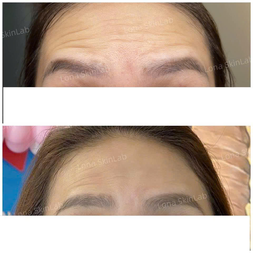 XÓA NHĂN LI TI TOÀN MẶT VỚI BOTOX TẠI LONA SKIN LAB