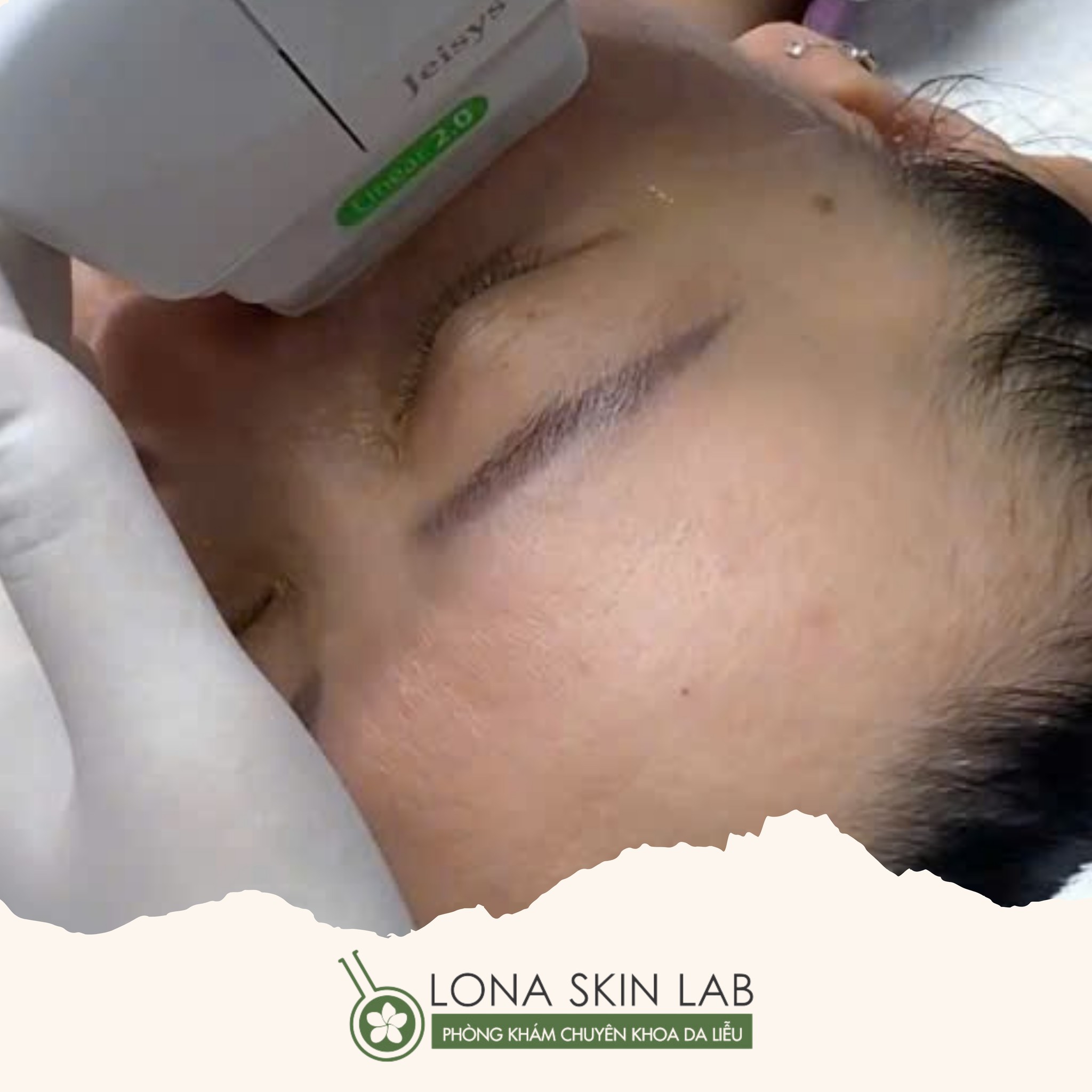 Được đánh giá cao trong y học thẩm mỹ, công nghệ HIFU không chỉ mang lại HIFU giảm bọng mắt hiệu quả mà còn hỗ trợ trẻ hóa da vùng mắt cùng với quy trình nâng cơ mắt không phẫu thuật, từ đó khẳng định hiệu quả HIFU vùng mắt.