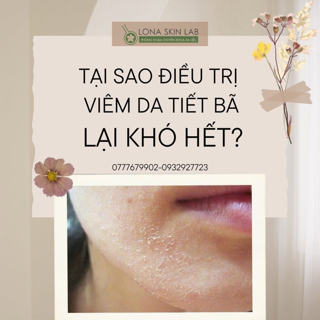 Tại sao viêm da tiết bã lại khó hết?