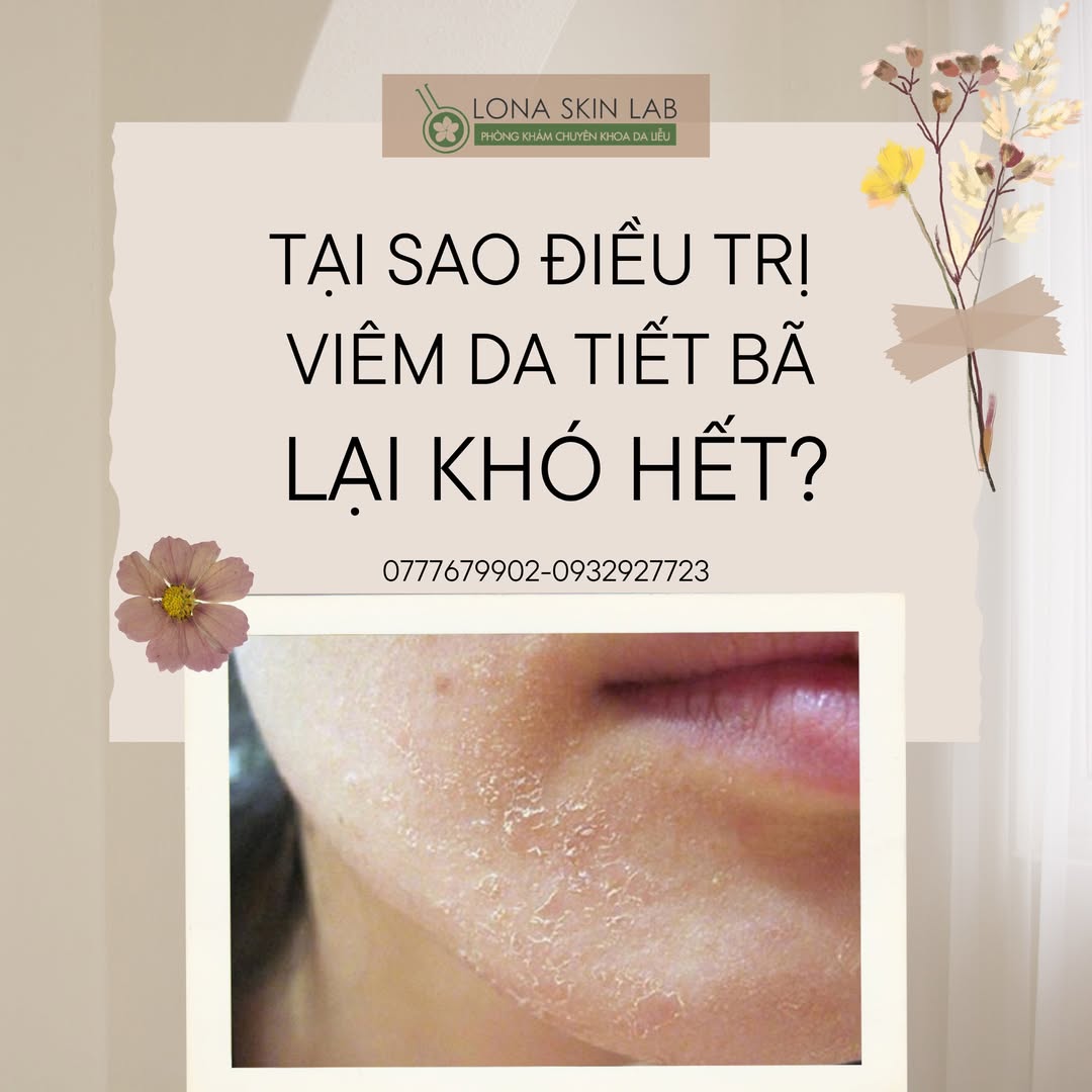 Hình ảnh trình bày viêm da tiết bã minh họa rõ ràng tình trạng da bị ảnh hưởng nghiêm trọng, nhấn mạnh nhu cầu điều trị viêm da tiết bã cấp cứu và các yếu tố nguyên nhân viêm da tiết bã có thể liên quan đến viêm da dầu, từ đó mở ra định hướng chữa viêm da tiết bã chuyên sâu.