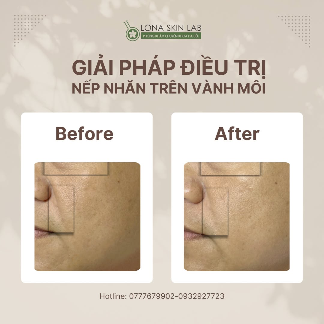 Minh họa quá trình triệt lông bằng IPL thông qua công nghệ IPL tiên tiến, xác nhận IPL là gì và hiệu quả điều trị mụn bằng IPL, nhấn mạnh ưu điểm của IPL trong liệu trình da liễu.