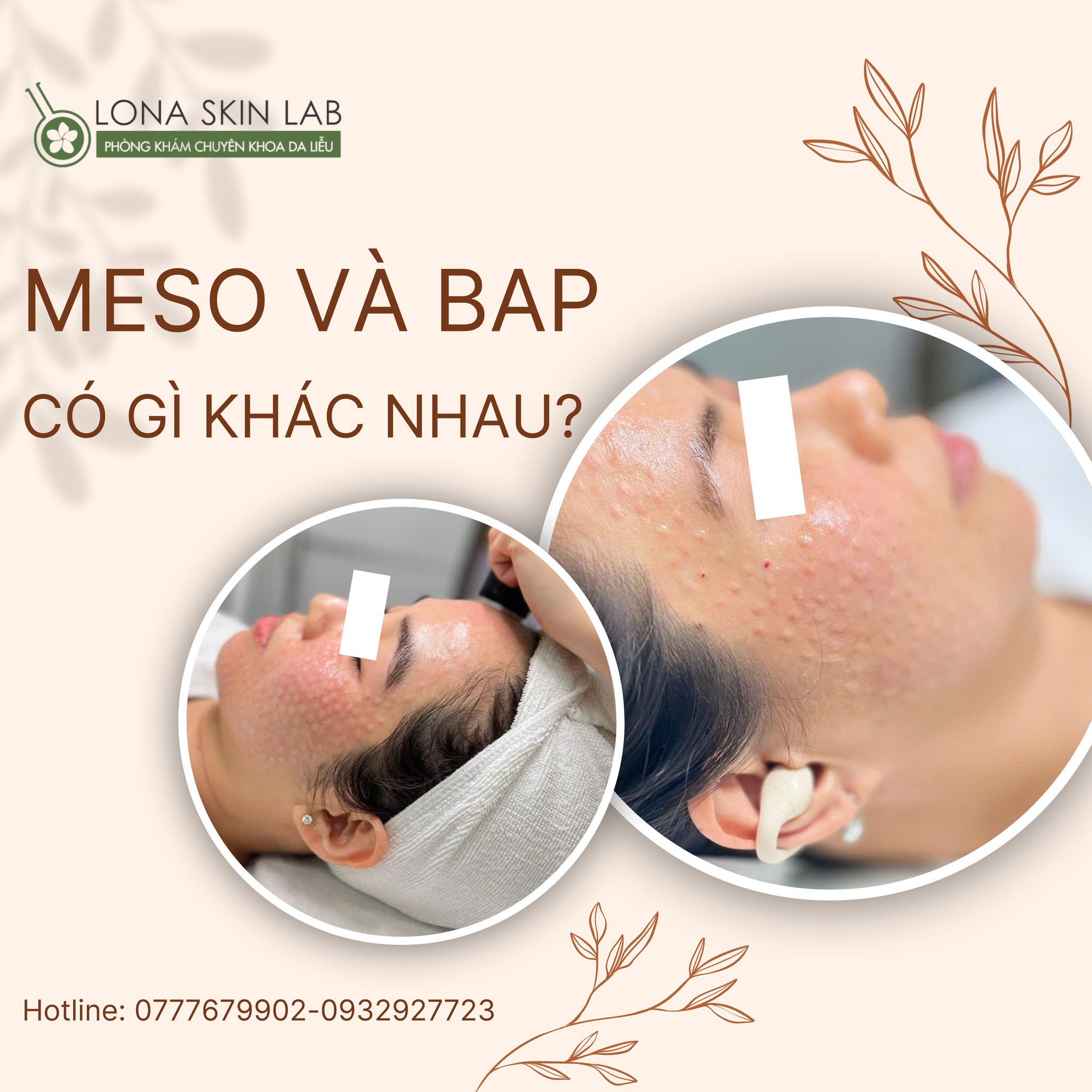 Tiêm BAP kết hợp với thành phần của Jalupro và Profhilo cho thấy hiệu quả vượt trội trong so sánh Jalupro và Profhilo về khả năng trẻ hóa da, từ việc kích thích collagen đến tái tạo cấu trúc da.
