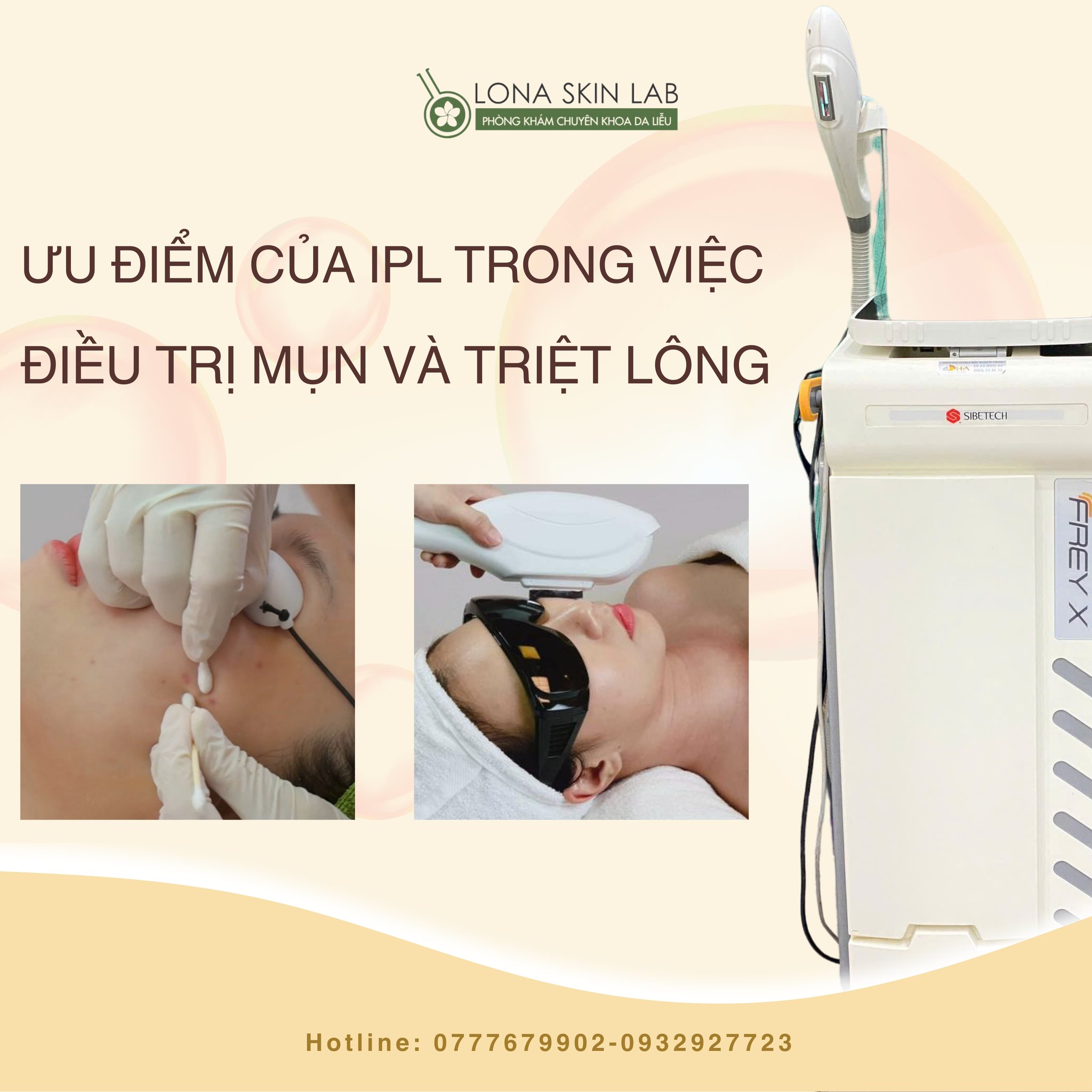 Ảnh mô tả IPL là gì qua công nghệ IPL tiên tiến, thể hiện rõ ưu điểm của IPL trong triệt lông bằng IPL và hỗ trợ điều trị mụn bằng IPL.