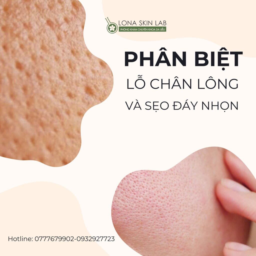 PHÂN BIỆT LỖ CHÂN LÔNG TO VÀ SẸO ĐÁY NHỌN: ĐÂU LÀ SỰ KHÁC BIỆT?