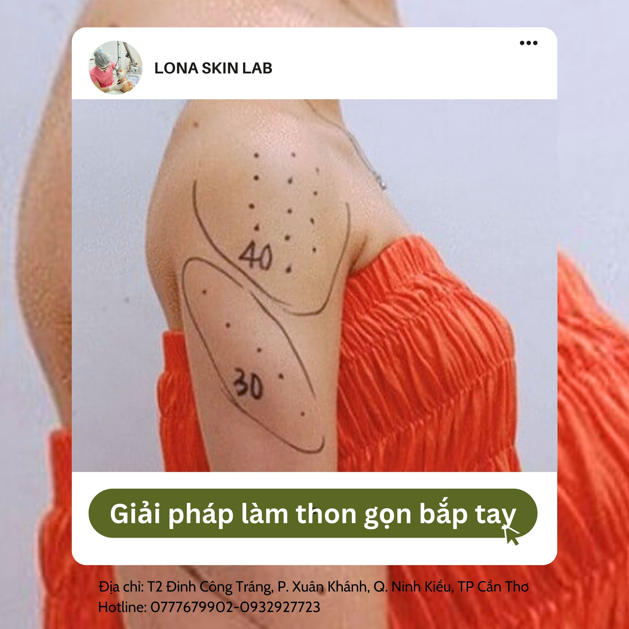 Giải pháp thon gọn bắp tay