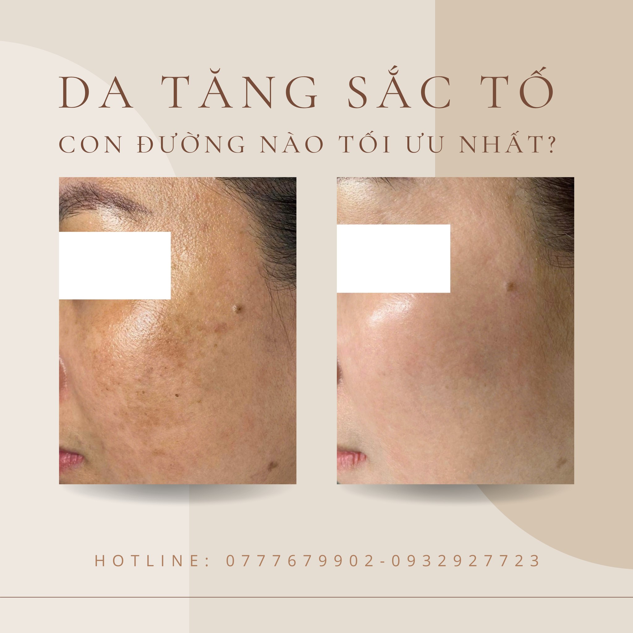Áp dụng công nghệ điều trị nám bằng laser, ca điều trị nám thành công được minh chứng khi tiêu chí trị nám đạt chuẩn, giúp phân biệt điều trị nám thành công thông qua việc kiểm chứng hiệu quả trị nám dựa trên dữ liệu khách quan.