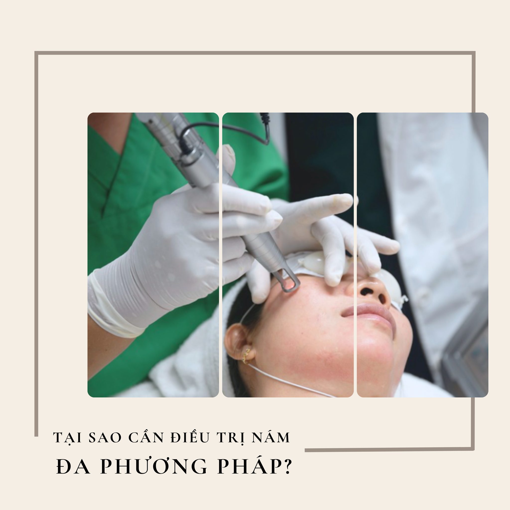 Qua quy trình chuẩn mực, điều trị nám đạt hiệu quả bền vững khi ca điều trị nám thành công được phân biệt điều trị nám thành công dựa trên tiêu chí trị nám khách quan và kiểm chứng hiệu quả trị nám thông qua các công cụ chuyên dụng.