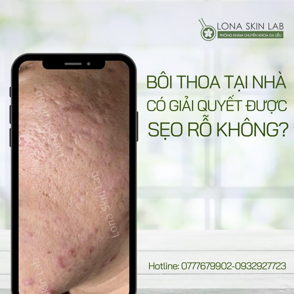 BÔI THOA TẠI NHÀ CÓ TRỊ ĐƯỢC SẸO RỖ KHÔNG?