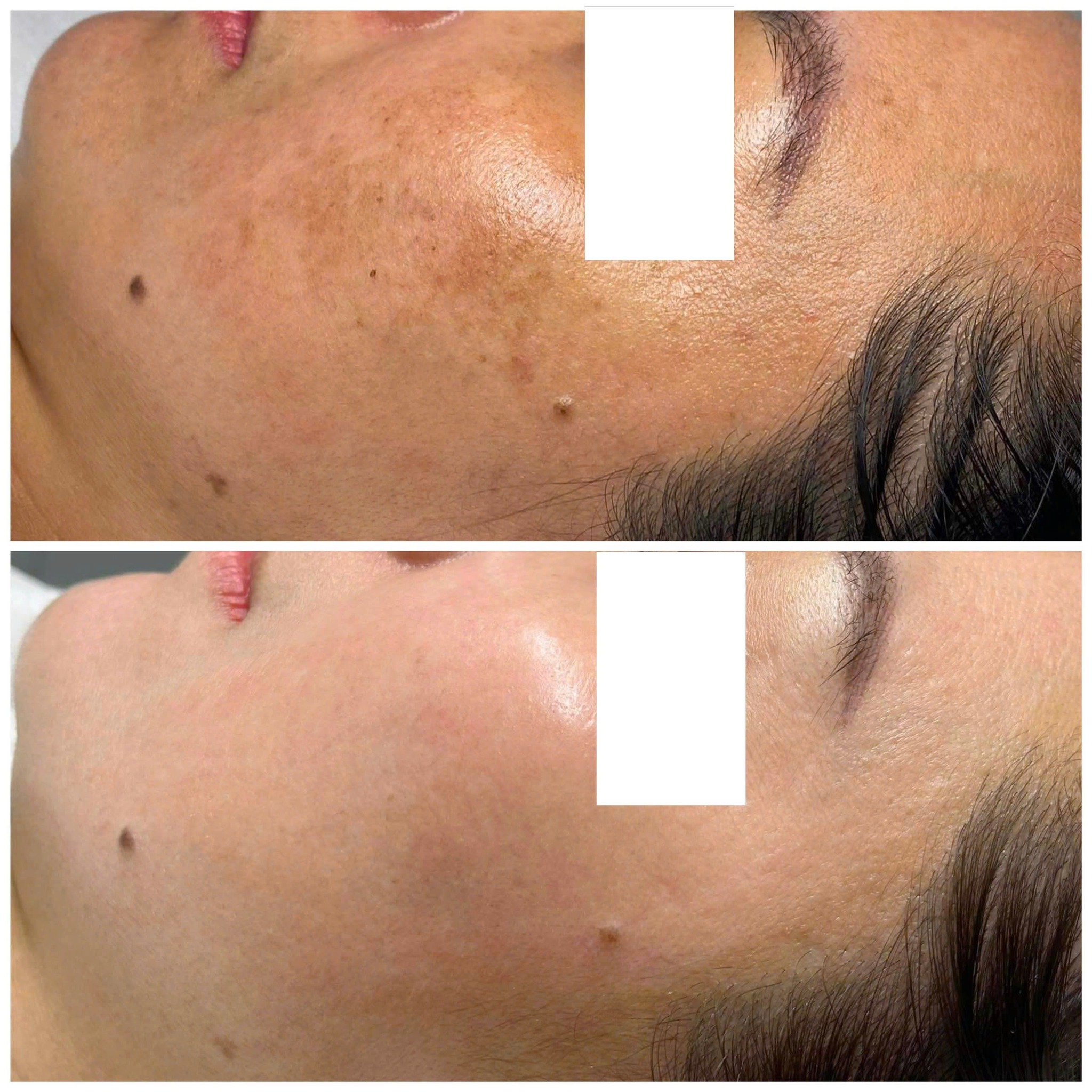 Áp dụng công nghệ laser hiện đại, ca điều trị nám thành công được khẳng định qua tiêu chí trị nám nghiêm túc và kiểm chứng hiệu quả trị nám bằng các chỉ số sinh học, giúp phân biệt điều trị nám thành công so với các liệu trình điều trị nám.