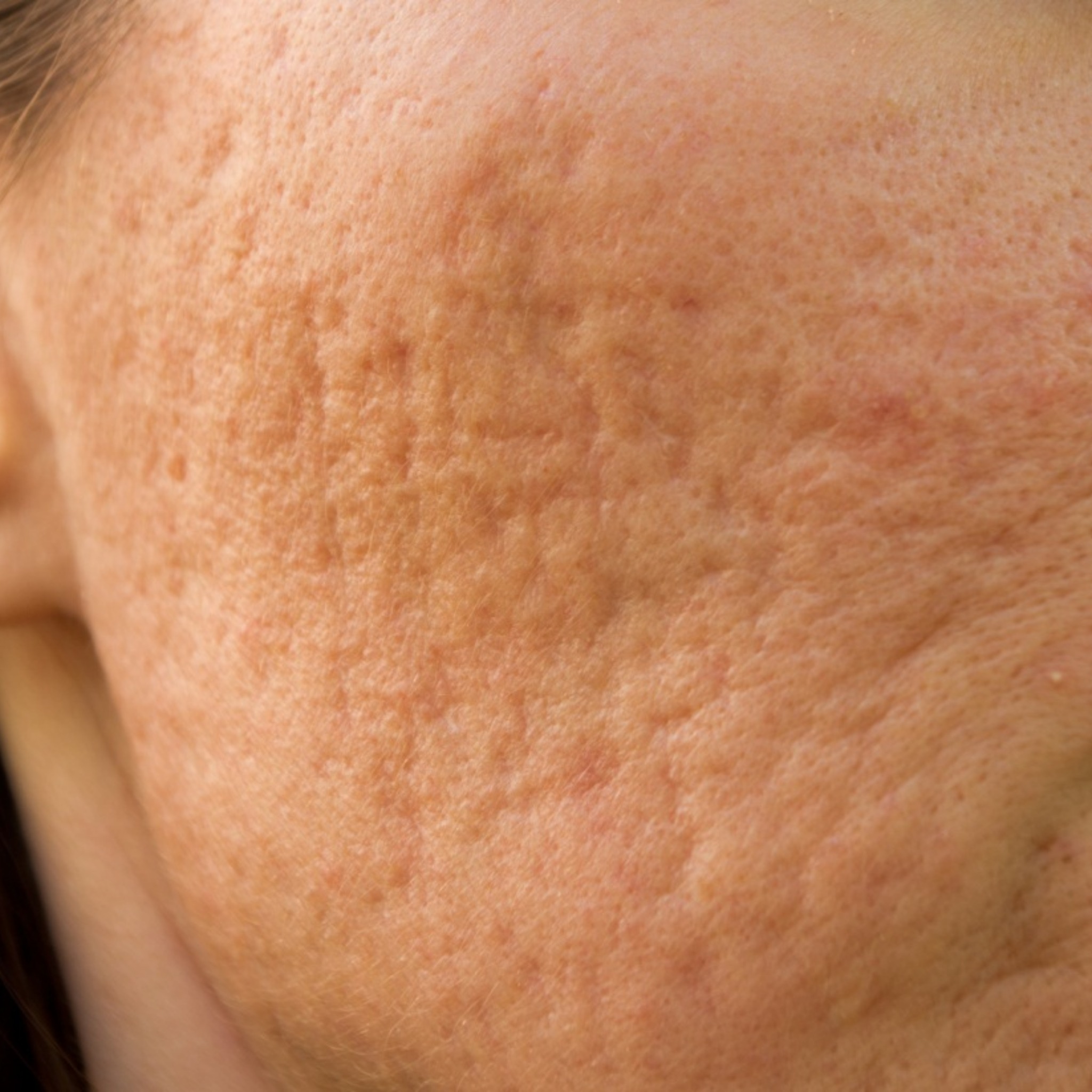 Hình ảnh này minh họa quy trình chuyên sâu của Lona Skin Lab về bí quyết điều trị mụn của Lona, cung cấp giải pháp điều trị mụn hiệu quả trong việc kiểm soát mụn trứng cá thông qua phác đồ điều trị mụn cá nhân hóa và bí quyết trị mụn an toàn.