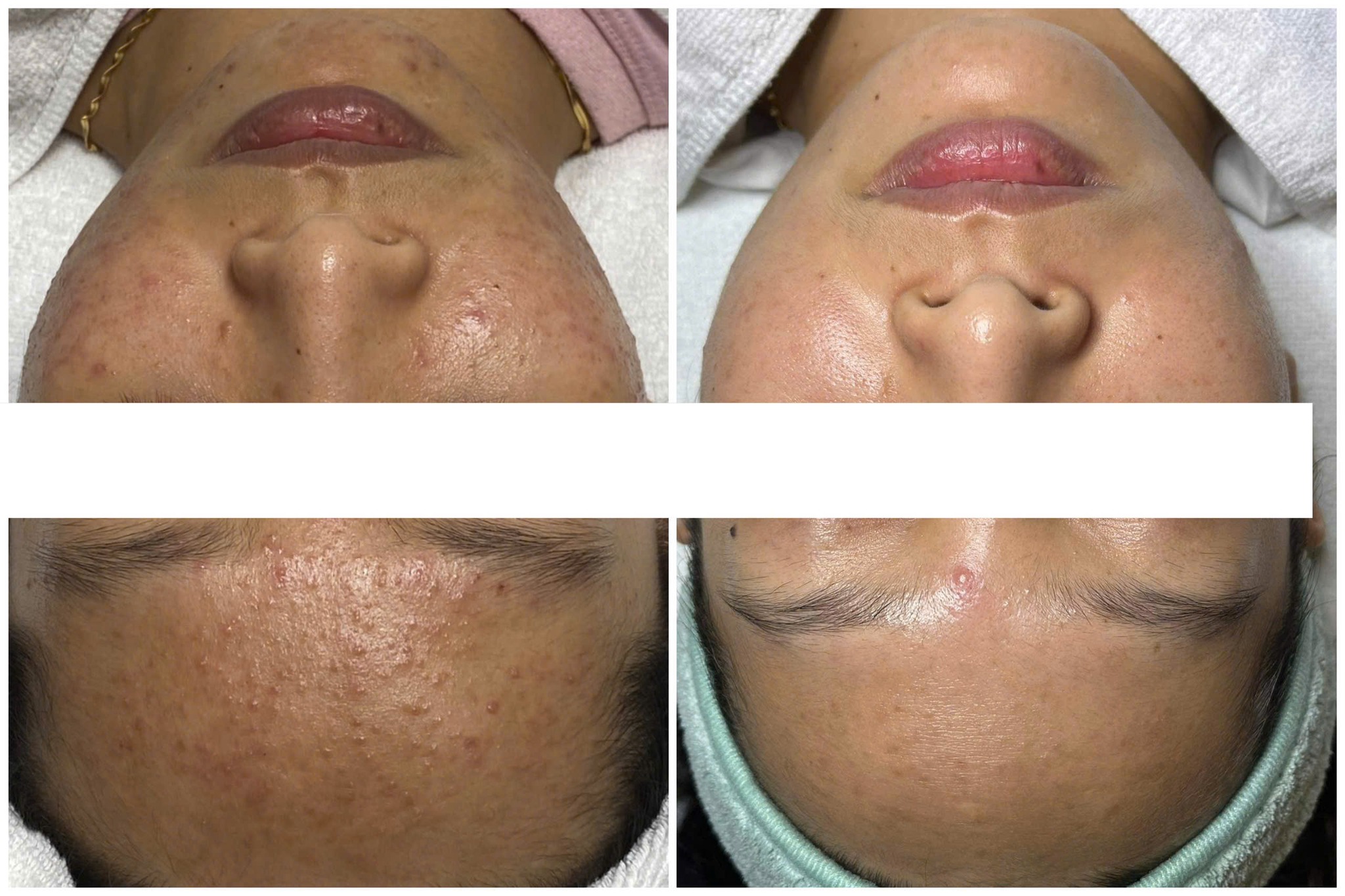 Qua việc áp dụng công nghệ tiên tiến, bí quyết điều trị mụn của Lona tại Lona Skin Lab đã tạo nên một phác đồ điều trị mụn toàn diện, giúp giảm nhanh các triệu chứng mụn trứng cá và nâng cao hiệu quả bí quyết trị mụn.