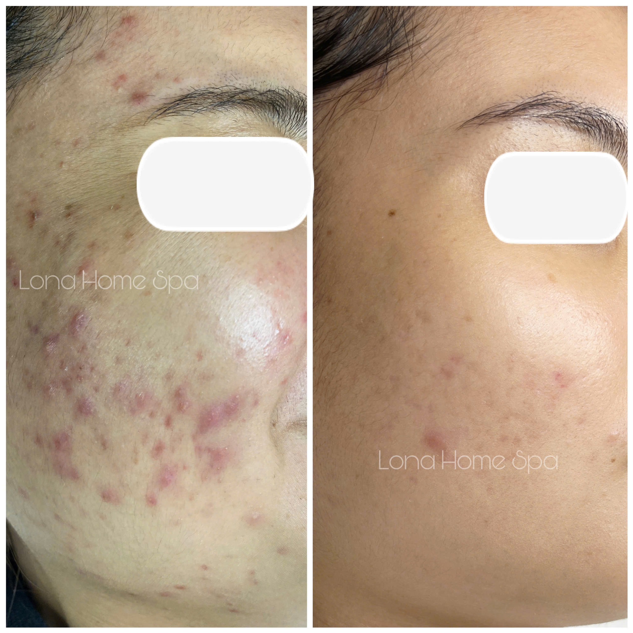 Áp dụng công nghệ Laser Carbon Peel, quy trình điều trị làm sạch da, thúc đẩy trẻ hóa da, thu nhỏ lỗ chân lông và giảm mụn trứng cá hiệu quả.