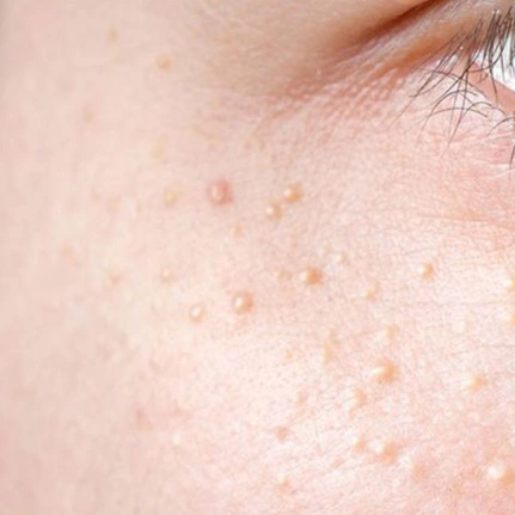 Công nghệ Laser CO2 Fractional tiên tiến hỗ trợ tái tạo da bằng laser CO2 fractional thông qua cơ chế hoạt động laser CO2 fractional, tạo ra lợi ích laser CO2 fractional ưu việt trong trẻ hóa da bằng laser CO2 cũng như điều trị sẹo bằng laser CO2.
