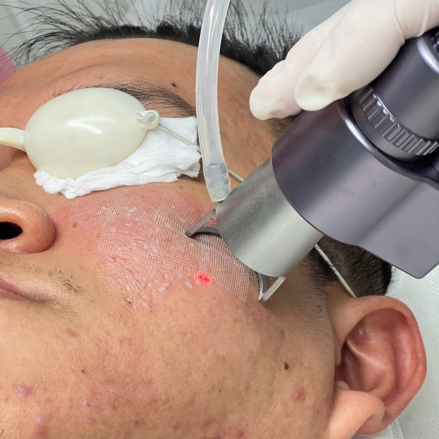 Phương pháp điều trị nám bằng laser cho thấy ca điều trị nám thành công khi tiêu chí trị nám được đáp ứng đầy đủ, giúp đối chiếu và phân biệt điều trị nám thành công qua việc kiểm chứng hiệu quả trị nám qua các chỉ số thực tế.
