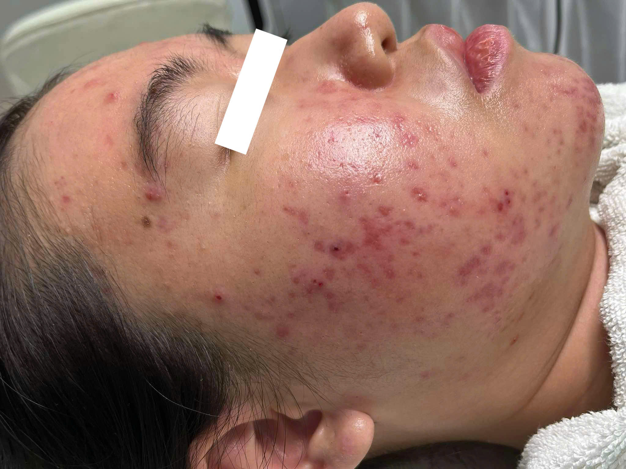 Liệu trình laser kết hợp với công nghệ tiên tiến giúp trị thâm bằng laser cải thiện làn da, trị mụn bằng laser khẳng định sự an toàn và hiệu quả.
