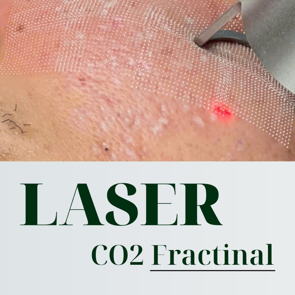 TÁI TẠO DA BẰNG LASER CO2 FRACTIONAL: HOẠT ĐỘNG VÀ LỢI ÍCH