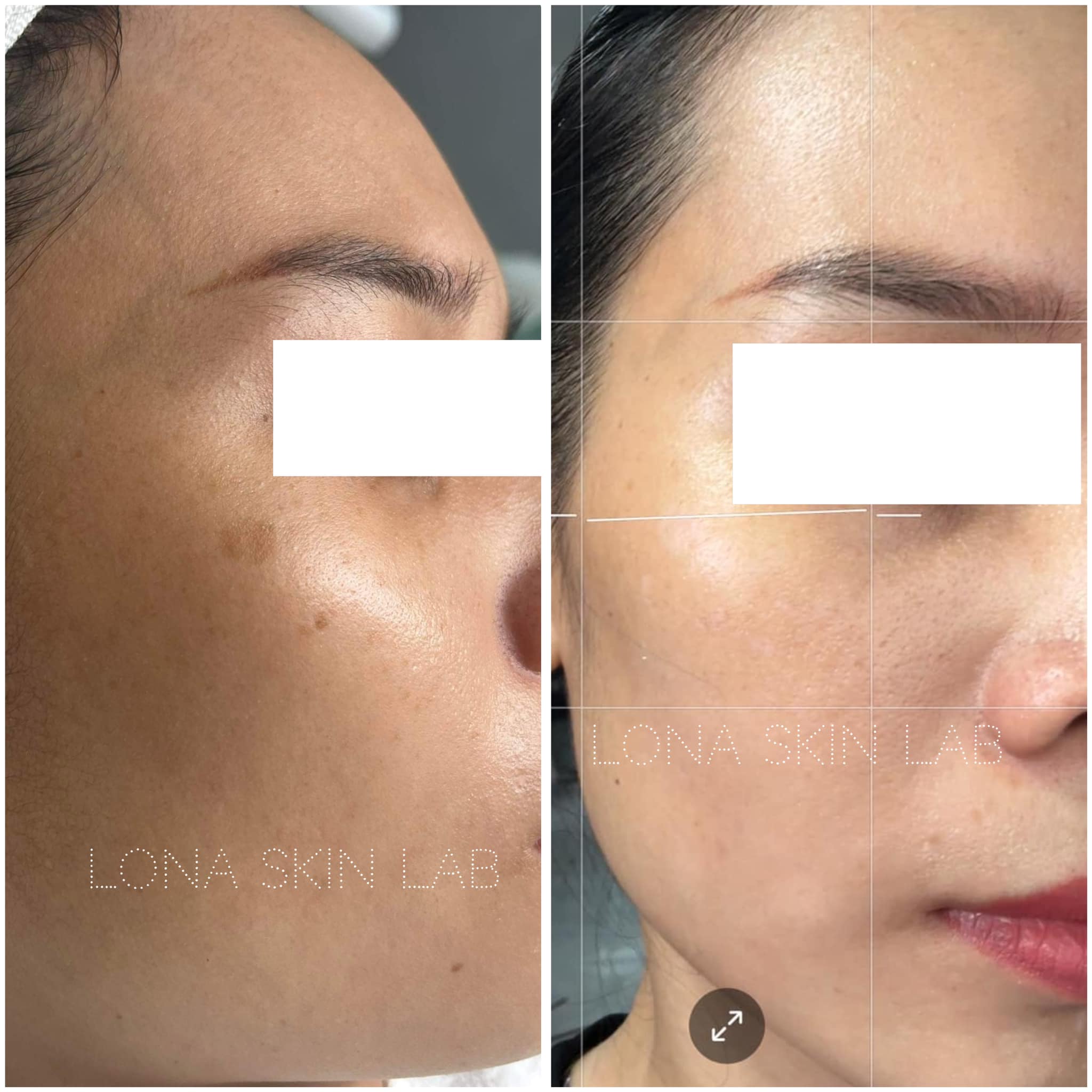 Quy trình điều trị mụn được minh chứng qua hình ảnh với sự kết hợp hiệu quả giữa điều trị mụn chuyên sâu và yếu tố điều trị mụn hiện đại, góp phần chăm sóc da chuyên nghiệp theo chuẩn lona.vn.