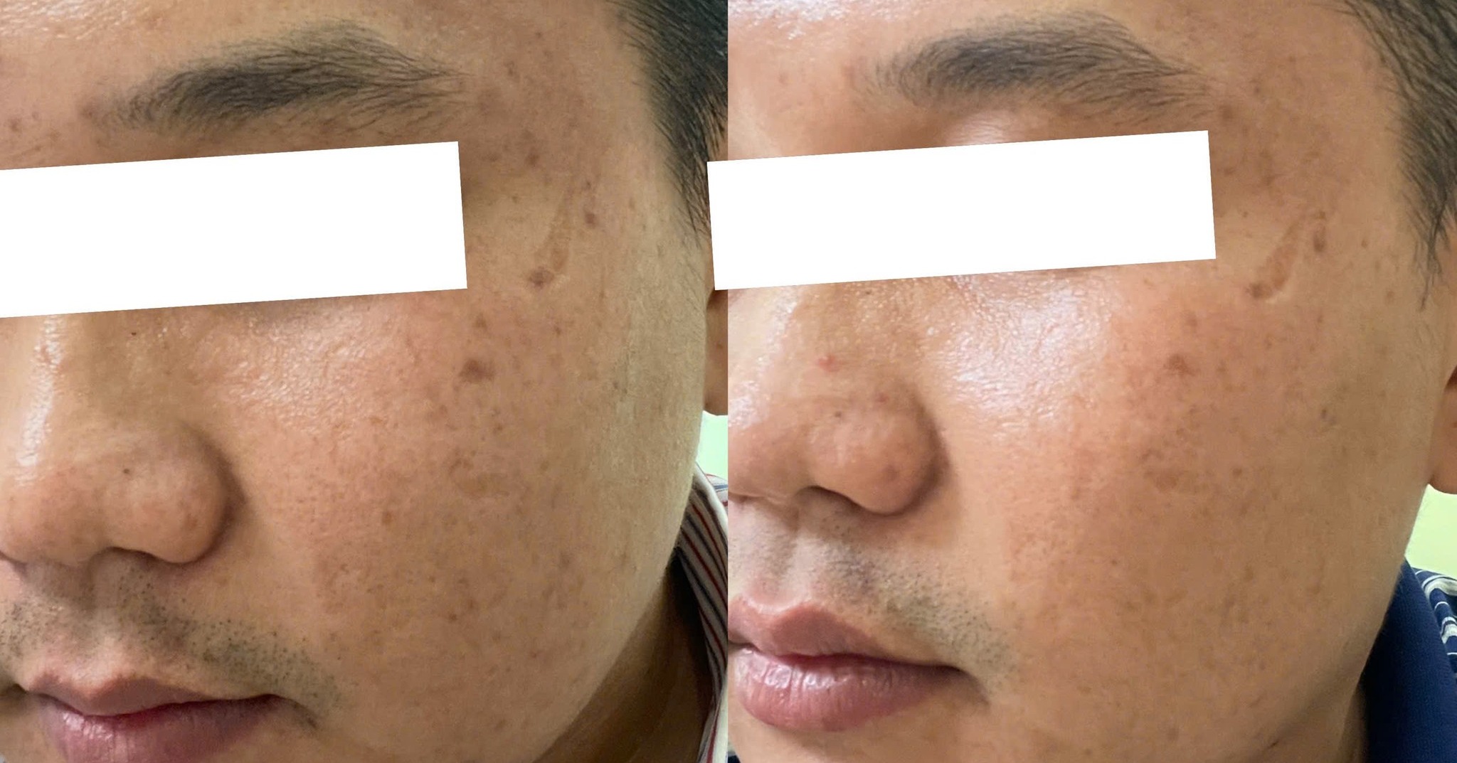 Công nghệ Laser Carbon Peel hiện đại hỗ trợ làm sạch da, trẻ hóa da, thu nhỏ lỗ chân lông và giảm mụn trứng cá, đảm bảo độ an toàn cho da nhờ vào hiệu quả đặc biệt.