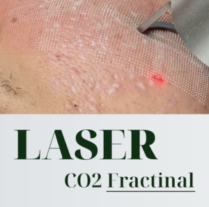 Laser Fractional CO2