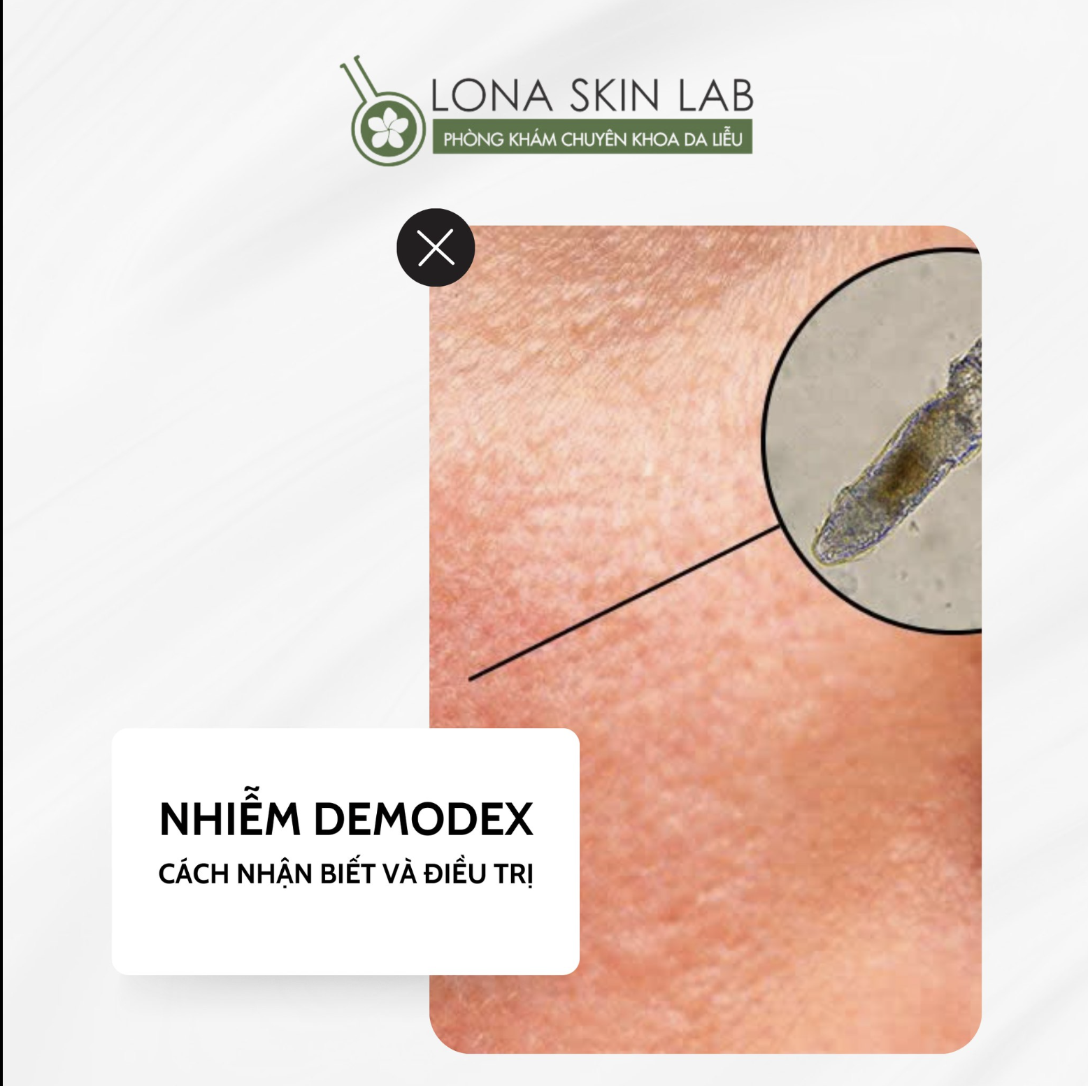 Bức ảnh phản ánh cách điều trị mụn tiên phong với các yếu tố điều trị mụn kết hợp điều trị mụn hiện đại, hỗ trợ chăm sóc da triệt để, là minh chứng cho điều trị mụn thành công tại lona.vn.
