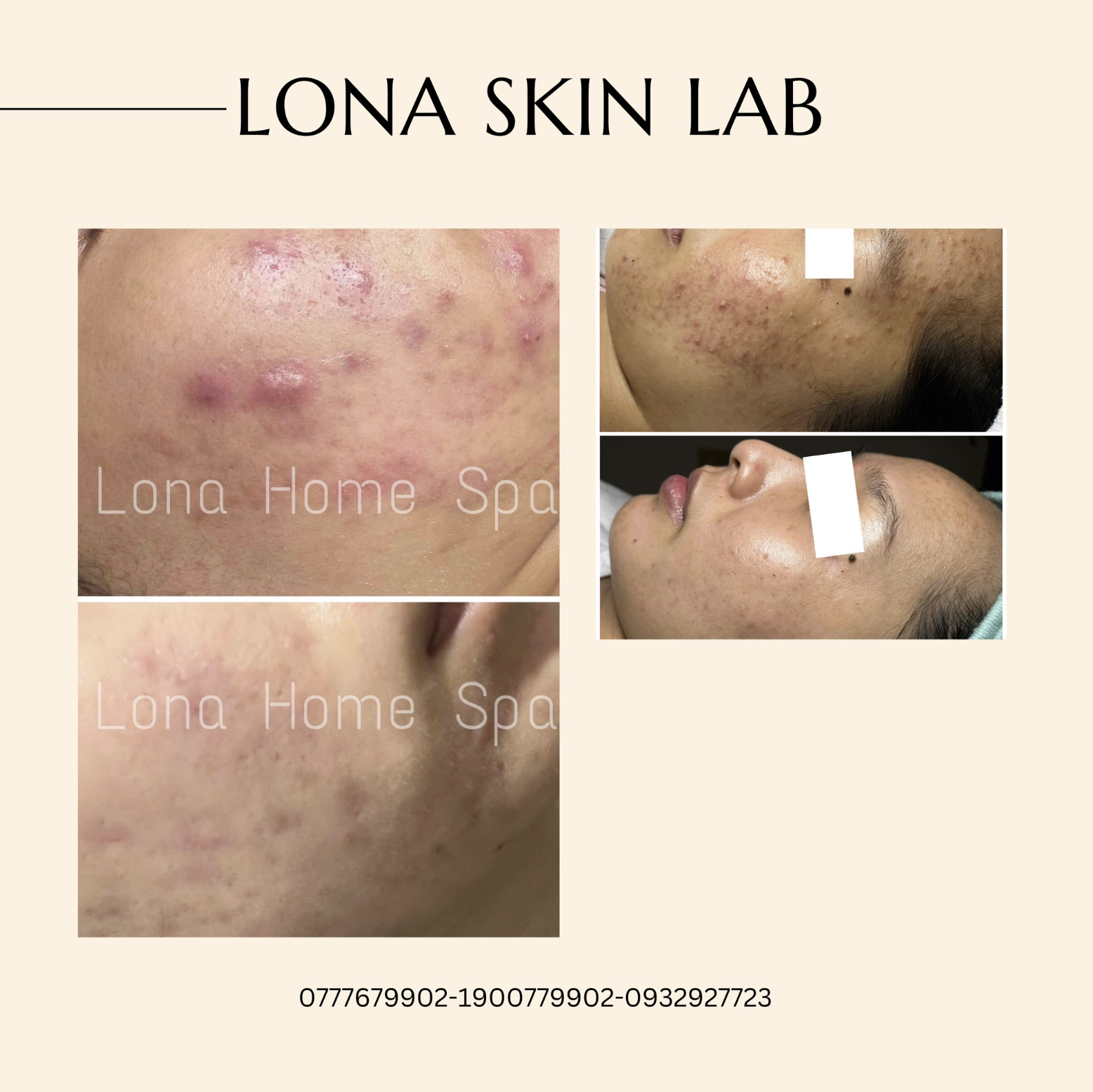 Bác sĩ khuyên dùng Isotretinoin vì hiệu quả Isotretinoin trong việc điều trị mụn trứng cá, song cần chú ý đến các tác dụng phụ Isotretinoin có thể xảy ra để duy trì làn da khỏe mạnh.