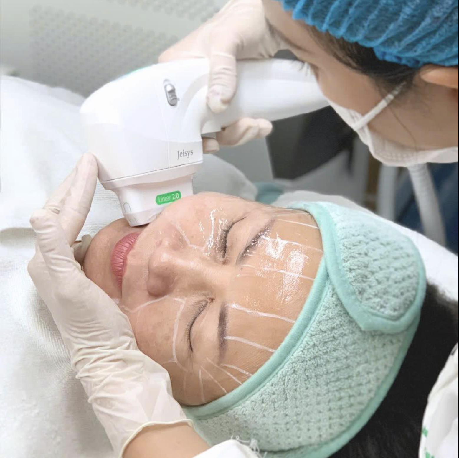 Minh họa laser gold toning trên da giúp thể hiện hiệu quả của gold toning, giải thích rằng toning là gì và nhấn mạnh tầm quan trọng của chăm sóc da sau laser toning để phòng tránh hiện tượng laser toning có bong da không.