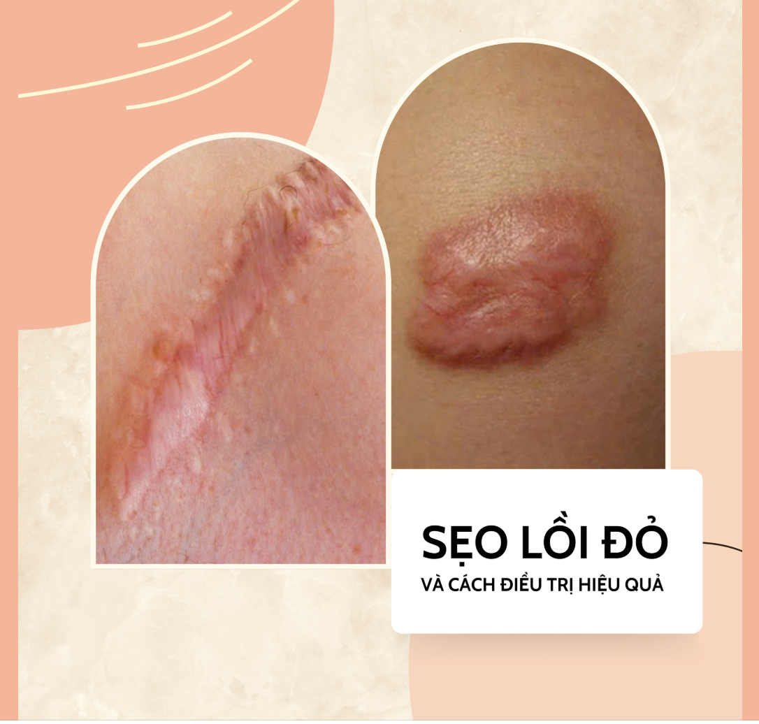 Quy trình cách điều trị sẹo lồi qua liệu trình tiêm thuốc và laser đã chứng minh khả năng giảm sẹo lồi đỏ, cải thiện làn da tự nhiên.