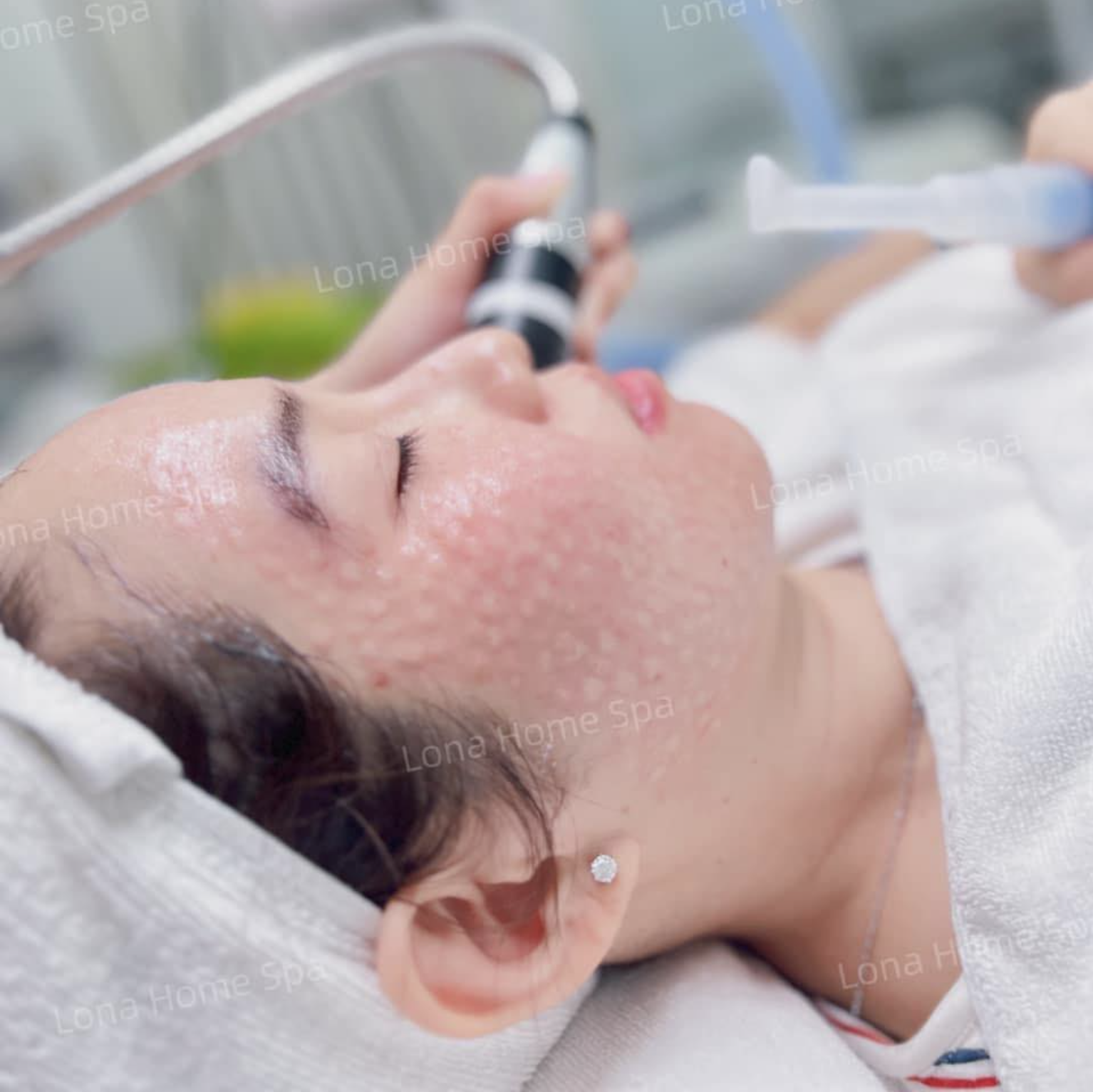 Phương pháp tiêm meso trị mụn sử dụng các loại meso trị mụn tiên tiến giúp làm sáng da và cải thiện làn da, cho thấy rằng tiêm meso trị mụn bao lâu có hiệu quả thường chỉ cần vài ngày.