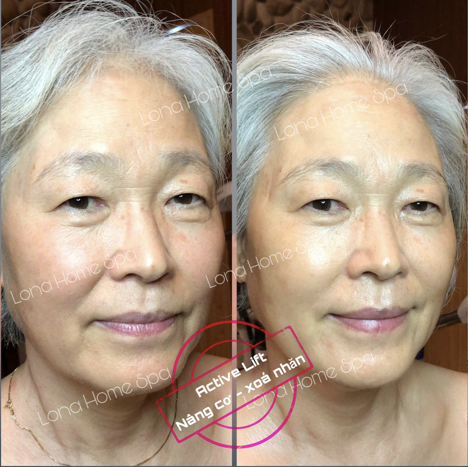 Bức ảnh này minh họa mụn đầu cứng lâu ngày, nhấn mạnh bằng phương pháp cách trị mụn chai không nhân an toàn, khuyến cáo mụn chai nên nặn không và khẳng định hiệu quả của sản phẩm làm mềm mụn chai trong làm giảm xơ hóa da.