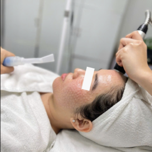 Mesobotox tại Lona Skin Lab